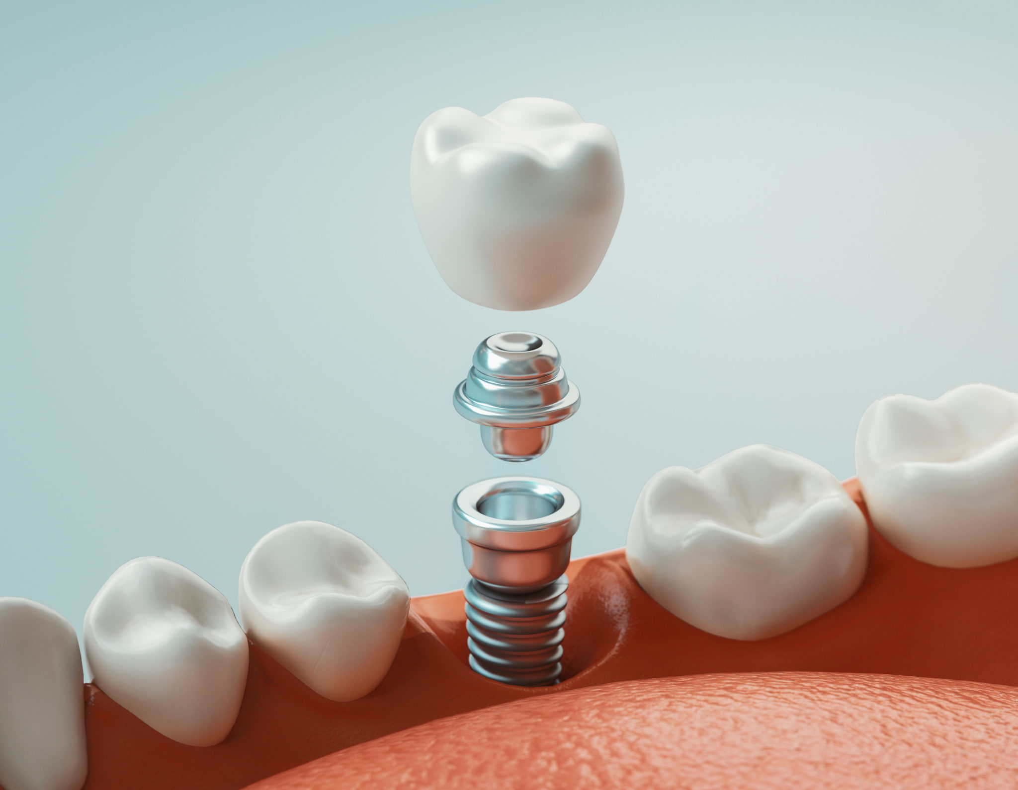 3D Implant Model