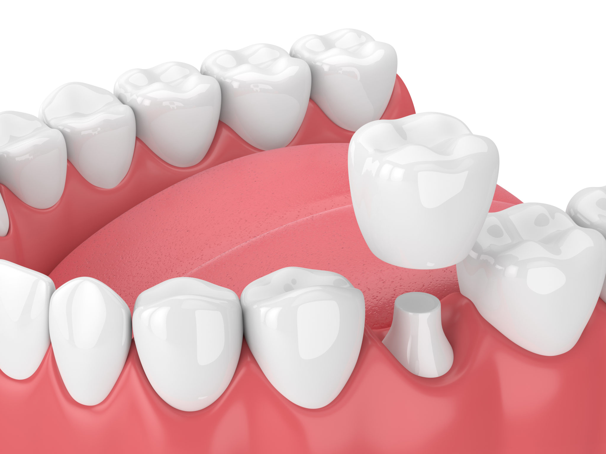 3D Model of a dental crown